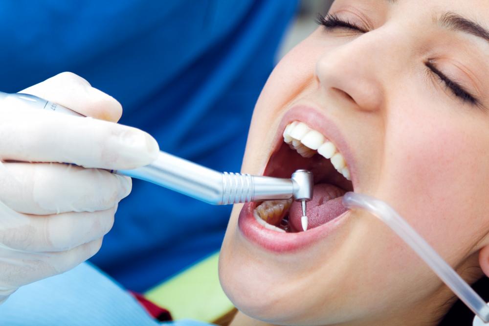 Os benefícios da limpeza profissional dos dentes