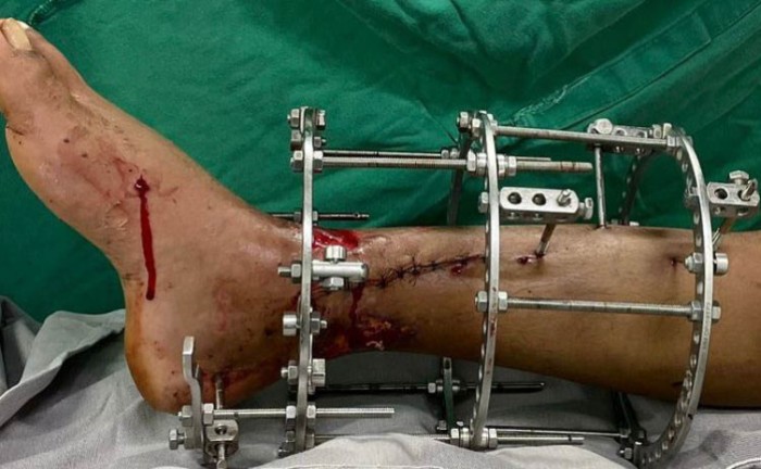 Cirurgia de Ilizarov oferece estabilidade e segurança ao paciente na recuperação - Foto: SES/Governo do Tocantins