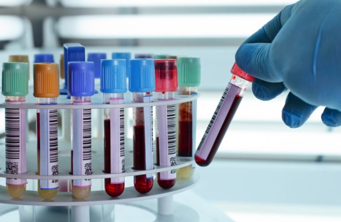 Diagnóstico é feito por meio de exames laboratoriais de sangue, urina e biópsia da medula óssea - (Foto: Depositphotos)