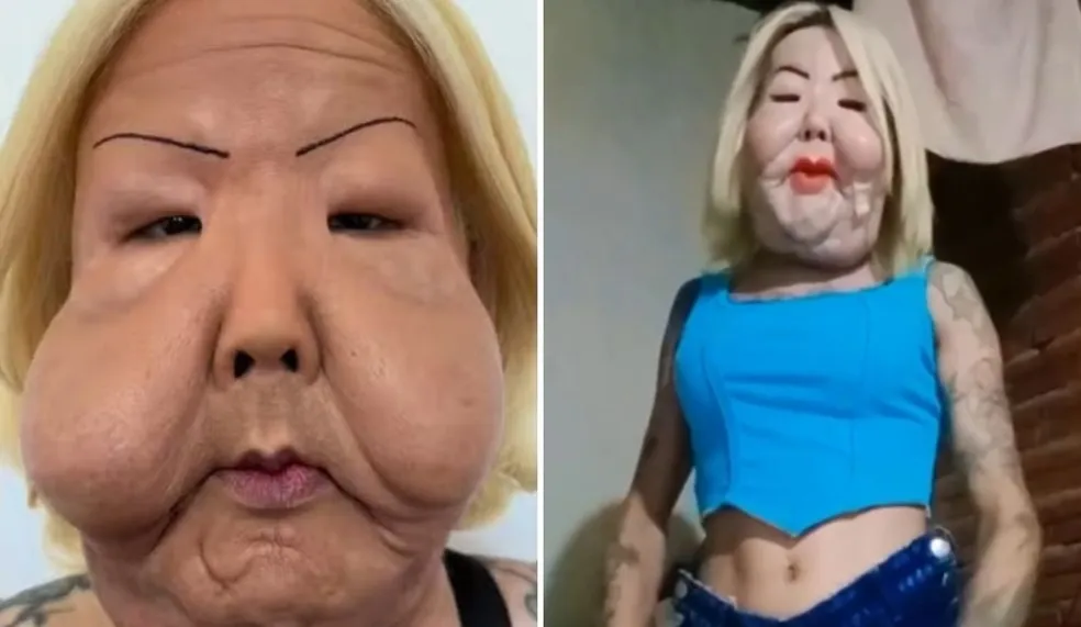 Juju do Pix antes (à esquerda) e depois da cirurgia reparadora para retirada de óleo mineral do rosto — Foto: Reprodução/Redes sociais
