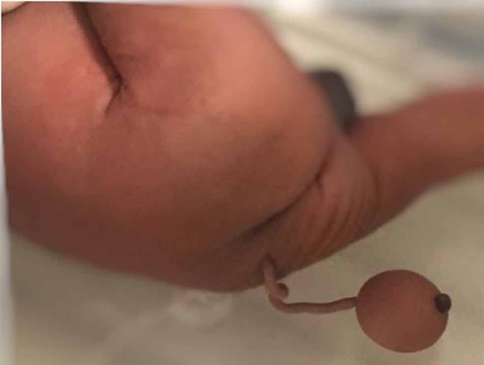 Bebê prematuro nasce com cauda de 12 centímetros que tinha bola na ponta — Foto: Journal of Pediatric Surgery Case Reports/Reprodução