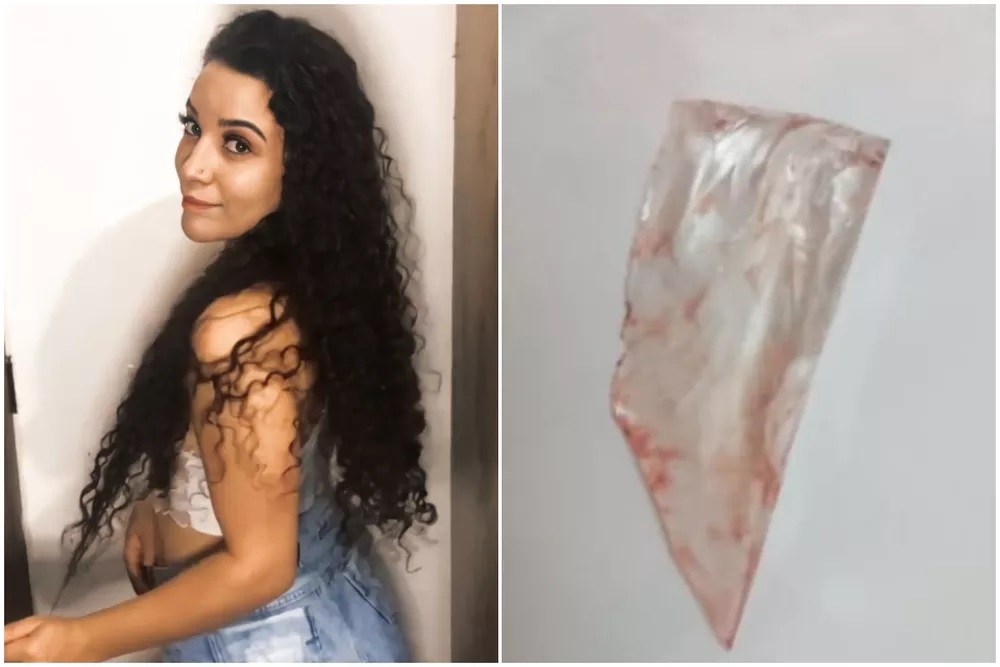 Jovem fica com caco de vidro alojado nas costas quase um mês após se ferir e hospital não perceber objeto — Foto: Arquivo Pessoal